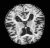 VeryMildDemented (103).jpg