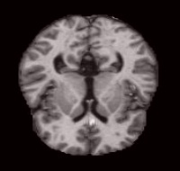 VeryMildDemented (143).jpg