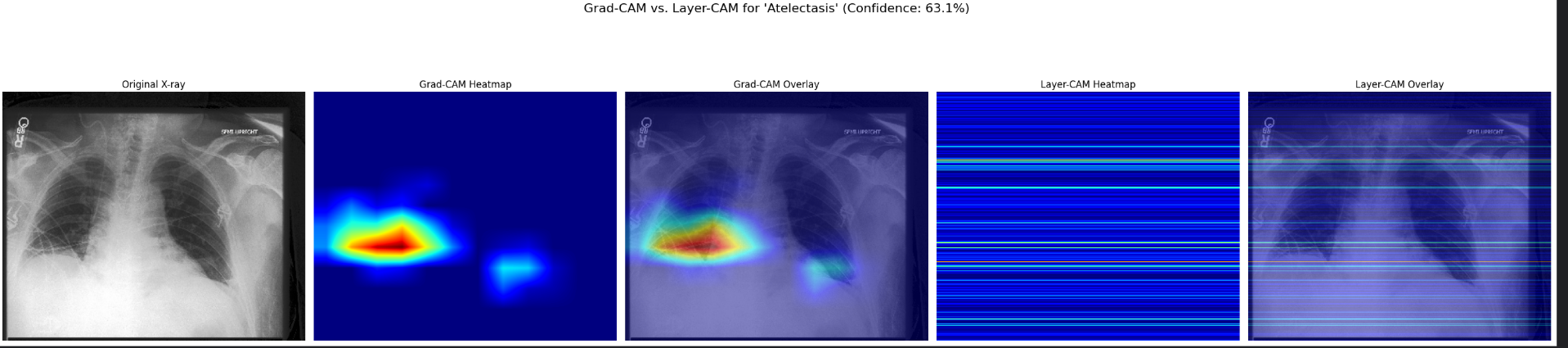 Atelectasis GradCAM